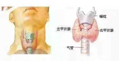 甲状腺肿大