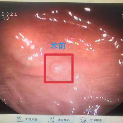 宜宾市矿山急救医院成功开展内镜下微创胃息肉电切除术