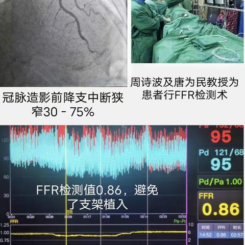 压力微导管指导下的冠心病精准诊疗