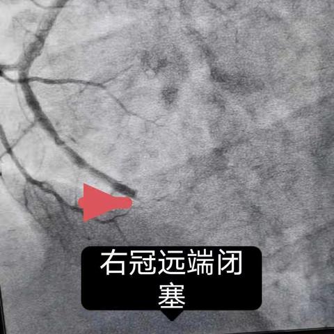 急性心梗已不再是老年人的专利