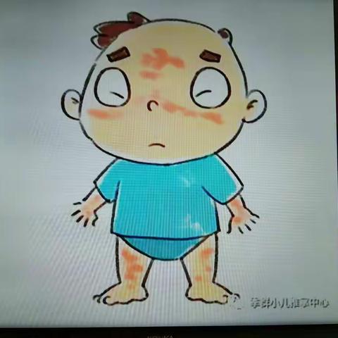 海口市龙桥镇中心幼儿园宝宝班《预防荨麻疹》健康教育活动