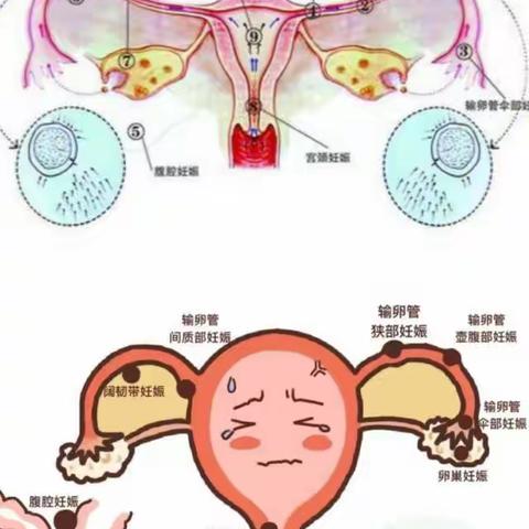 迷路的“孩子”——异位妊娠