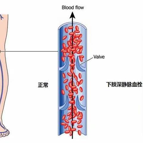 深静脉血栓的预防宣教