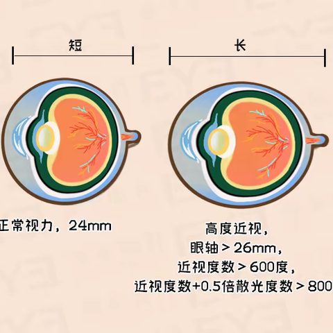 近视超过600度，这些运动不要做