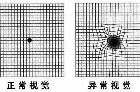 警惕黄斑变性！